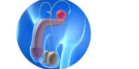 prostatectomia